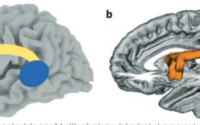 NEUROLOGICAL BASES OF MUSICAL DISORDERS AND THEIR IMPLICATIONS FOR STROKE RECOVERY – Psyche Loui, Catherine Y. Wan, and Gottfried Schlaug